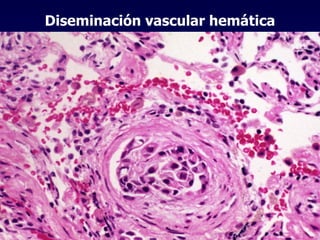 Diseminación vascular hemática 