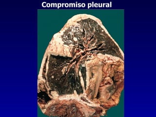 Compromiso pleural 