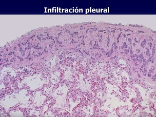 Infiltración pleural 