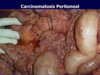 Carcinomatosis Peritoneal 