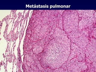 Metástasis pulmonar 