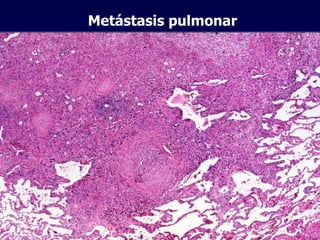 Metástasis pulmonar 