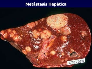 Metástasis   Hepática 