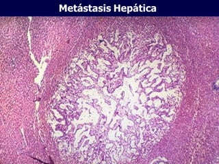 Metástasis   Hepática 