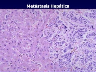 Metástasis   Hepática 