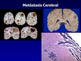 Metástasis   Cerebral 