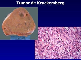 Tumor de Kruckemberg 