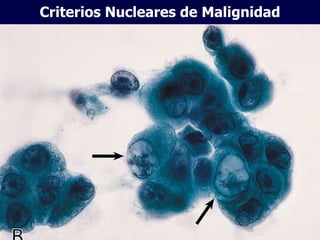 Criterios Nucleares de Malignidad 