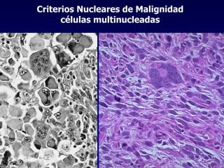 Criterios Nucleares de Malignidad células multinucleadas 