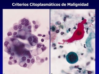 Criterios Citoplasmáticos de Malignidad 