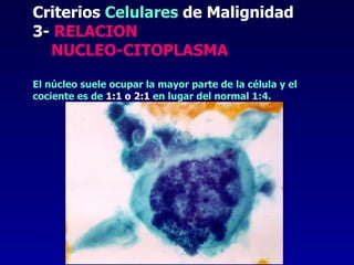 Criterios  Celulares  de Malignidad 3-  RELACION    NUCLEO-CITOPLASMA El núcleo suele ocupar la mayor parte de la célula y el cociente es de  1:1 o 2:1  en lugar del normal 1:4. 