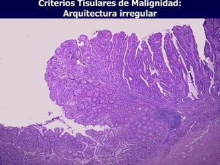 Criterios Tisulares de Malignidad: Arquitectura irregular 