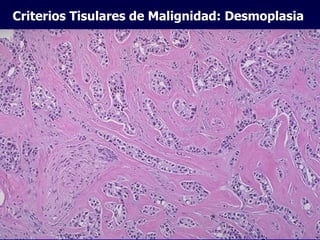 Criterios Tisulares de Malignidad: Desmoplasia   