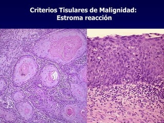 Criterios Tisulares de Malignidad:  Estroma reacción 