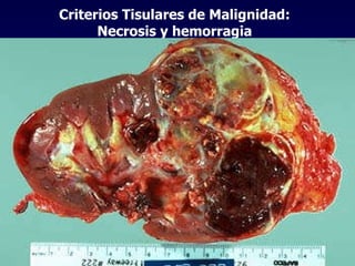 Criterios Tisulares de Malignidad: Necrosis y hemorragia 