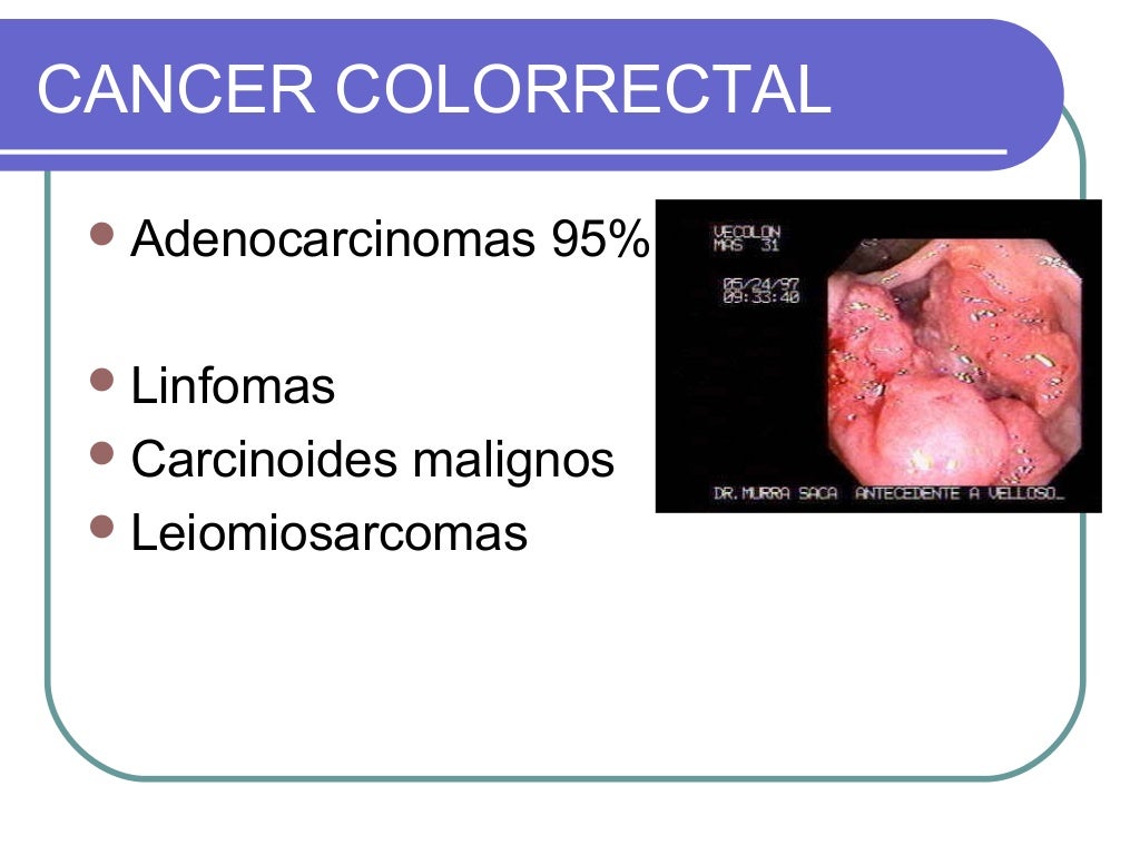 Neoplasias malignas de intestino grueso Neoplasias malignas de intestino grueso