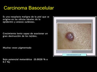 Carcinoma BasocelularCarcinoma Basocelular
Es una neoplasia maligna de la piel que se
origina en las células básales de la
epidermis y anexos cutáneos.
Crecimiento lento capaz de ocasionar un
gran destrucción de los tejidos.
Muchas veces pigmentado
Bajo potencial metastático (0.0028 % a
0.1 %)
 