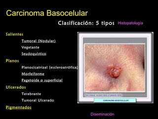 Clasificación: 5 tiposClasificación: 5 tipos
Carcinoma BasocelularCarcinoma Basocelular
SalientesSalientes
Tumoral (Nodular)Tumoral (Nodular)
VegetanteVegetante
SeudoquísticoSeudoquístico
PlanosPlanos
Planocicatrizal (escleroatrófica)Planocicatrizal (escleroatrófica)
MorfeiformeMorfeiforme
Pagetoide o superficialPagetoide o superficial
UlceradosUlcerados
TerebranteTerebrante
Tumoral UlceradoTumoral Ulcerado
PigmentadosPigmentados
Histopatología
Diseminación
 