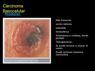 CarcinomaCarcinoma
BasocelularBasocelular
Nodular
Más frecuente.
Lesión Saliente
Lobulado
Semiesférica
Eritematosa o violácea, borde
perlado
Telangiectasias.
Se puede lesionar o ulcerar al
crecer.
Puede contener melanina
(confusión)
 