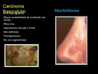 CarcinomaCarcinoma
BasocelularBasocelular Morfeiforme
Es el más agresivo
Mayor probabilidad de confundir con
herida
Placa Lisa
Ligeramente elevada y firme
Mal definidas
Telangiectasias.
No son pigmentadas
 