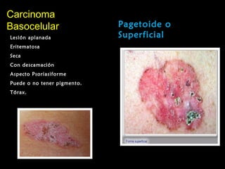 CarcinomaCarcinoma
BasocelularBasocelular Pagetoide o
SuperficialLesión aplanada
Eritematosa
Seca
Con descamación
Aspecto Psoriasiforme
Puede o no tener pigmento.
Tórax.
 