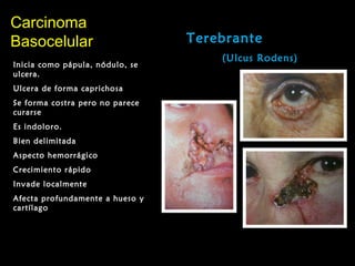 CarcinomaCarcinoma
BasocelularBasocelular Terebrante
(Ulcus Rodens)
Inicia como pápula, nódulo, se
ulcera.
Ulcera de forma caprichosa
Se forma costra pero no parece
curarse
Es indoloro.
Bien delimitada
Aspecto hemorrágico
Crecimiento rápido
Invade localmente
Afecta profundamente a hueso y
cartílago
 