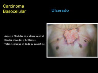 CarcinomaCarcinoma
BasocelularBasocelular Ulcerado
Aspecto Nodular con ulcera central
Bordes elevados y brillantes
Telangiectasias en toda su superficie.
 