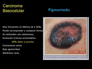 CarcinomaCarcinoma
BasocelularBasocelular Pigmentado
Muy frecuentes en México (6 a 16%)
Puede corresponder a cualquier forma.
Se confunden con melanomas.
Evolución Crónica asintomática
30% dolor o prurito.
Crecimiento Lento
Baja agresividad
Metástasis raras
 