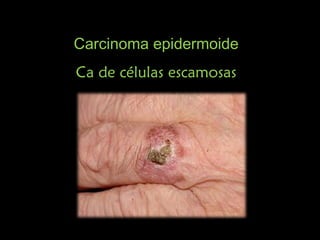 Carcinoma epidermoideCarcinoma epidermoide
Ca de células escamosasCa de células escamosas
 