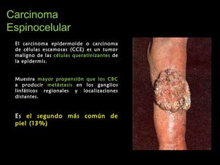 CarcinomaCarcinoma
EspinocelularEspinocelular
El carcinoma epidermoide o carcinoma
de células escamosas (CCE) es un tumor
maligno de las células queratinizantes de
la epidermis.
Muestra mayor propensión que los CBC
a producir metástasis en los ganglios
linfáticos regionales y localizaciones
distantes.
Es el segundo más común de
piel (13%)
 