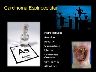 Carcinoma EspinocelularCarcinoma Espinocelular
Hidrocarburos
Arsénico
Rayos X
Quemaduras
Ulceras
Dermatosis
Crónicas
VPH 16 y 18
Albinismo
 