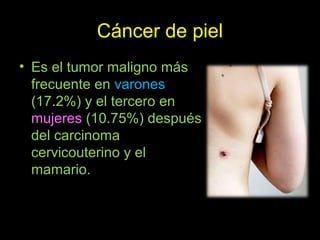 Cáncer de piel
• Es el tumor maligno más
frecuente en varones
(17.2%) y el tercero en
mujeres (10.75%) después
del carcinoma
cervicouterino y el
mamario.
 