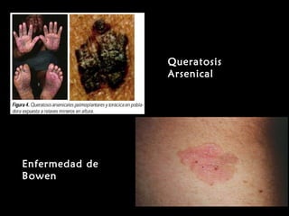 QueratosisQueratosis
ArsenicalArsenical
Enfermedad deEnfermedad de
BowenBowen
 