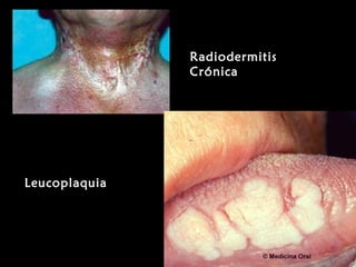 RadiodermitisRadiodermitis
CrónicaCrónica
LeucoplaquiaLeucoplaquia
 