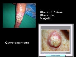 Úlceras Crónicas:Úlceras Crónicas:
Úlceras deÚlceras de
Marjolin.Marjolin.
QueratoacantomaQueratoacantoma
 