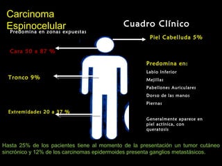 CarcinomaCarcinoma
EspinocelularEspinocelular Cuadro Clínico
Predomina en zonas expuestas
Cara 50 a 87 %
Tronco 9%
Piel Cabelluda 5%
Predomina en:
Labio Inferior
Mejillas
Pabellones Auriculares
Dorso de las manos
Piernas
Generalmente aparece en
piel actínica, con
queratosis
Extremidades 20 a 37 %
Hasta 25% de los pacientes tiene al momento de la presentación un tumor cutáneo
sincrónico y 12% de los carcinomas epidermoides presenta ganglios metastásicos.
 