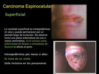 Carcinoma EspinocelularCarcinoma Espinocelular
Superficial
La variedad superficial es intraepidérmica
(in situ) y puede permanecer por un
periodo largo de evolución. Se observa
como una placa eritematosa de uno o
varios centímetros, se le conoce como
enfermedad de Bowen o eritroplasia de
Queyrat si afecta al pene.
Intraepidérmica por meses o años
Se trata de un insitu
Solía incluirse en los precanceres
 