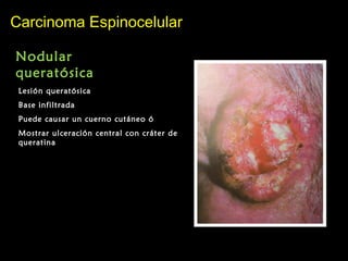 Carcinoma EspinocelularCarcinoma Espinocelular
Nodular
queratósica
Lesión queratósica
Base infiltrada
Puede causar un cuerno cutáneo ó
Mostrar ulceración central con cráter de
queratina
 
