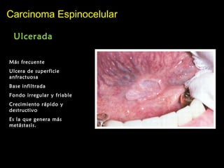 Carcinoma EspinocelularCarcinoma Espinocelular
Ulcerada
Más frecuente
Ulcera de superficie
anfractuosa
Base infiltrada
Fondo irregular y friable
Crecimiento rápido y
destructivo
Es la que genera más
metástasis.
 