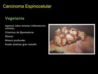 Carcinoma EspinocelularCarcinoma Espinocelular
Vegetante
Aparece sobre lesiones inflamatorias
crónicas.
Cicatrices de Quemaduras
Úlceras
Micosis profundas
Puede alcanzar gran tamaño
 