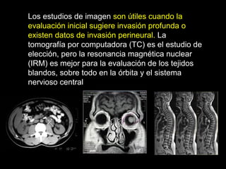 Los estudios de imagen son útiles cuando la
evaluación inicial sugiere invasión profunda o
existen datos de invasión perineural. La
tomografía por computadora (TC) es el estudio de
elección, pero la resonancia magnética nuclear
(IRM) es mejor para la evaluación de los tejidos
blandos, sobre todo en la órbita y el sistema
nervioso central
 