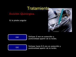 TratamientoTratamiento
Escisión Quirúrgica.Escisión Quirúrgica.
Es la piedra angular
CBCCBCCBCCBC
CECCECCECCEC
Extirpar hasta 2.5 cms en extensión y
profundidad apartir de la lesión.
Extirpar 5 mm en extensión y
profundidad apartir de la lesión.
 