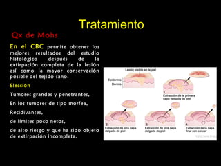 TratamientoTratamiento
Qx de MohsQx de Mohs
En el CBC permite obtener los
mejores resultados del estudio
histológico después de la
extirpación completa de la lesión
así como la mayor conservación
posible del tejido sano.
Elección
Tumores grandes y penetrantes,
En los tumores de tipo morfea,
Recidivantes,
de límites poco netos,
de alto riesgo y que ha sido objeto
de extirpación incompleta,
 