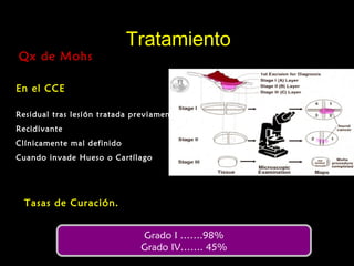 TratamientoTratamiento
Qx de MohsQx de Mohs
En el CCE
Residual tras lesión tratada previamente
Recidivante
Clínicamente mal definido
Cuando invade Hueso o Cartílago
Grado I …….98%
Grado IV……. 45%
Tasas de Curación.
 