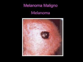 Melanoma MalignoMelanoma Maligno
MelanomaMelanoma
 