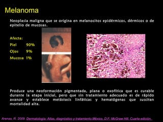 MelanomaMelanoma
Neoplasia maligna que se origina en melanocitos epidérmicos, dérmicos o de
epitelio de mucosas.
Afecta:
Piel 90%
Ojos 9%
Mucosa 1%
Produce una neoformación pigmentada, plana o exofítica que es curable
durante la etapa inicial, pero que sin tratamiento adecuado es de rápido
avance y establece metástasis linfáticas y hematógenas que suscitan
mortalidad alta.
Arenas, R. 2009. Dermatología: Atlas, diagnóstico y tratamiento.México, D.F: McGraw Hill. Cuarta edición.
 