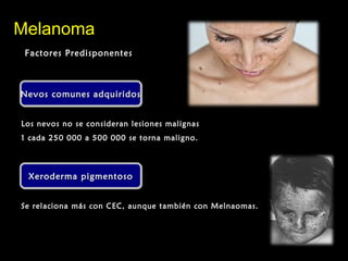 Nevos comunes adquiridosNevos comunes adquiridosNevos comunes adquiridosNevos comunes adquiridos
MelanomaMelanoma
Factores PredisponentesFactores Predisponentes
Los nevos no se consideran lesiones malignas
1 cada 250 000 a 500 000 se torna maligno.
Xeroderma pigmentosoXeroderma pigmentosoXeroderma pigmentosoXeroderma pigmentoso
Se relaciona más con CEC, aunque también con Melnaomas.
 