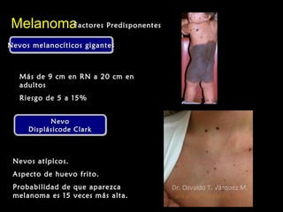 Nevos melanocíticos gigantesNevos melanocíticos gigantesNevos melanocíticos gigantesNevos melanocíticos gigantes
MelanomaMelanoma
Más de 9 cm en RN a 20 cm enMás de 9 cm en RN a 20 cm en
adultosadultos
Riesgo de 5 a 15%Riesgo de 5 a 15%
Factores PredisponentesFactores Predisponentes
NevoNevo
Displásicode ClarkDisplásicode Clark
NevoNevo
Displásicode ClarkDisplásicode Clark
Nevos atípicos.Nevos atípicos.
Aspecto de huevo frito.Aspecto de huevo frito.
Probabilidad de que aparezcaProbabilidad de que aparezca
melanoma es 15 veces más alta.melanoma es 15 veces más alta.
 