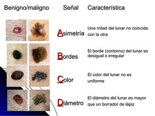 Benigno/malignoBenigno/maligno SeñalSeñal CaracterísticaCaracterística
AAsimetríasimetría
Una mitad del lunar no coincideUna mitad del lunar no coincide
con la otracon la otra
BBordesordes
El borde (contorno) del lunar esEl borde (contorno) del lunar es
desigual o irregulardesigual o irregular
CColorolor
El color del lunar no esEl color del lunar no es
uniformeuniforme
DDiámetroiámetro
El diámetro del lunar es mayorEl diámetro del lunar es mayor
que un borrador de lápizque un borrador de lápiz
 