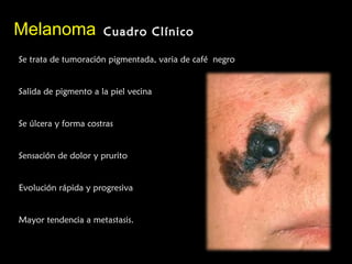 MelanomaMelanoma Cuadro ClínicoCuadro Clínico
Se trata de tumoración pigmentada, varia de café negro
Salida de pigmento a la piel vecina
Se úlcera y forma costras
Sensación de dolor y prurito
Evolución rápida y progresiva
Mayor tendencia a metastasis.
 